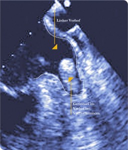 Blutgerinnsel im linken Vorhof.